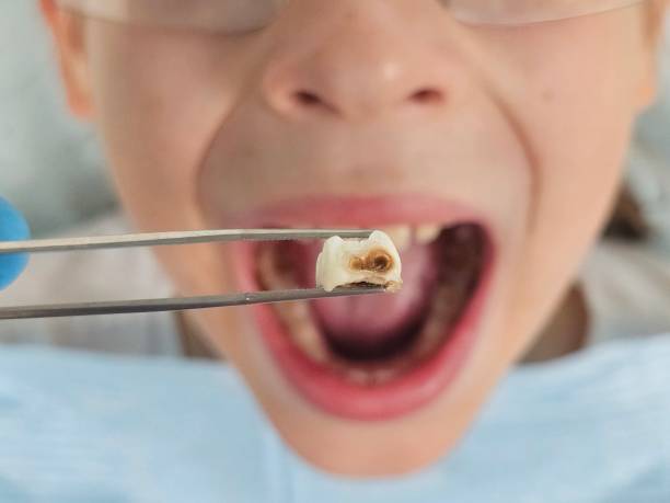 Best Same-Day Emergency Dental Services in Clay City, KY